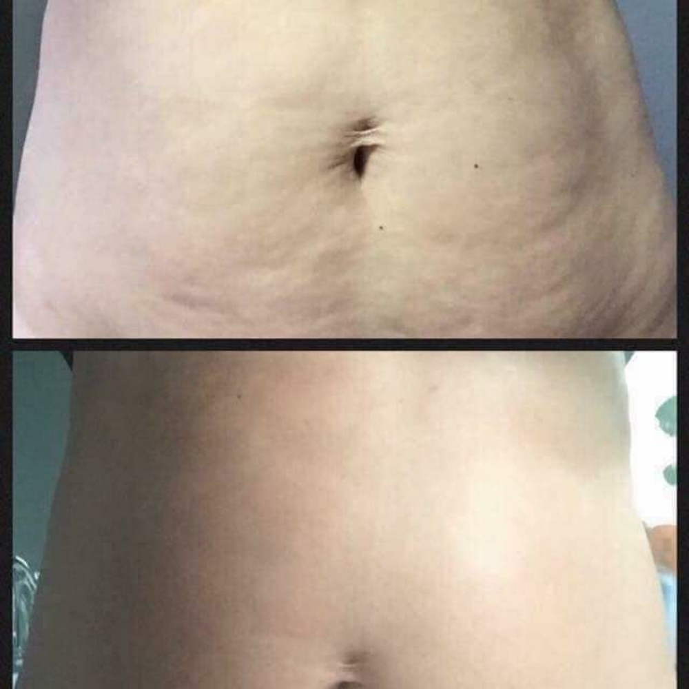 PREORDER ONLY Cellulite & Body Toning Treatment